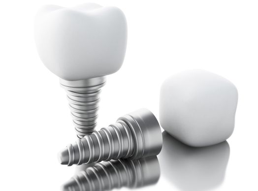Zahnimplantate Eingriff und Versorgung